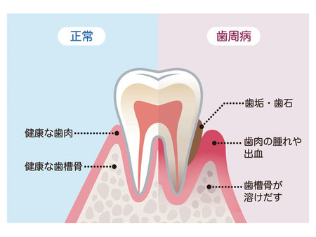 正常な歯と歯周病になっている歯の違い